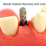 Healing Time for Dental Implant